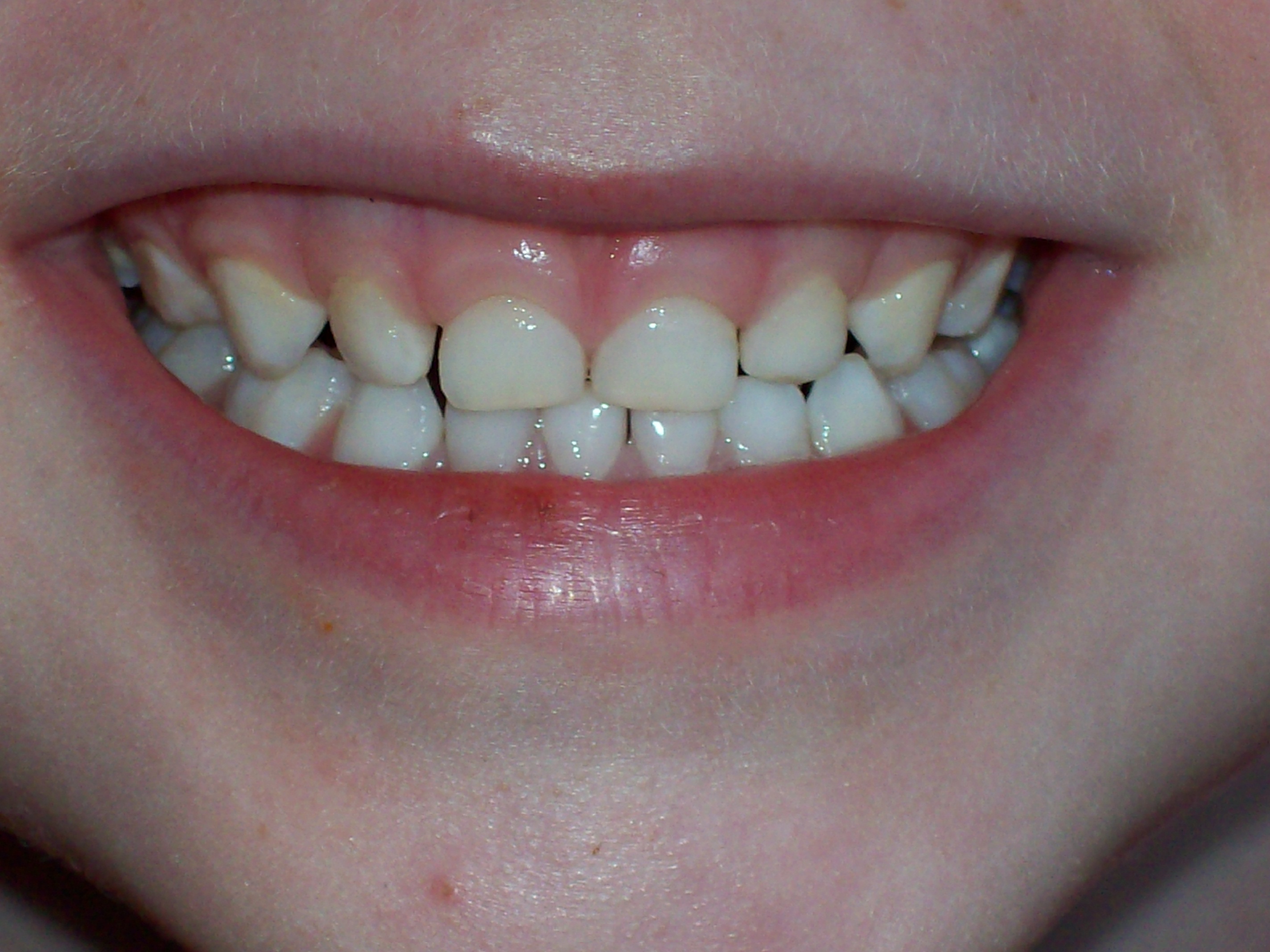 子供の虫歯は黒いのだけじゃないって本当？