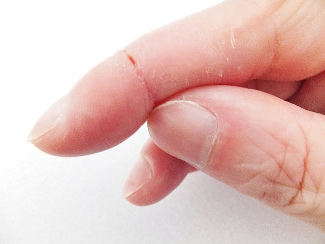 指にできるかゆい湿疹。関節にできるのはどんな病気？