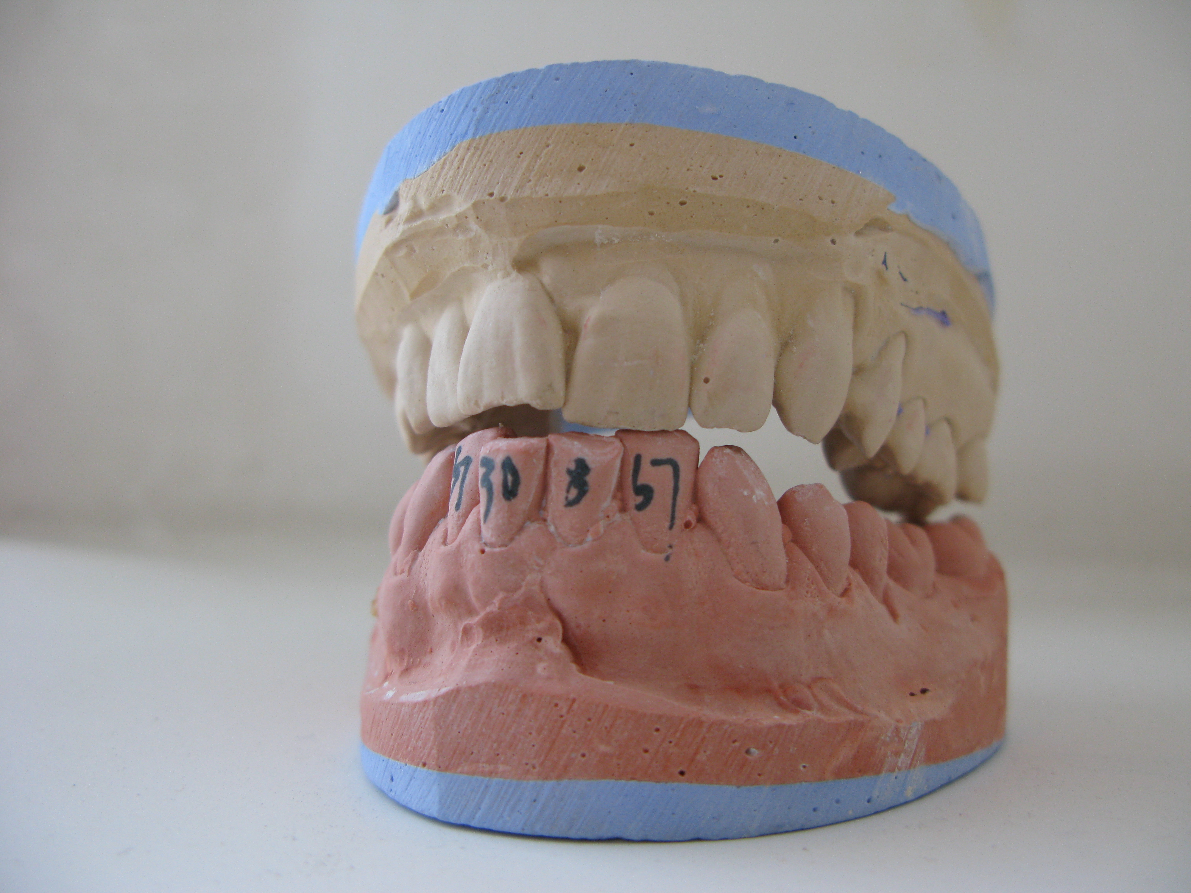 前歯をブリッジにしたい場合、保険は適用されるの？